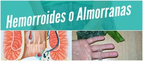 hemorroides externas fotos|Hemorroides o almorranas: tipos, tratamientos y fotos